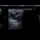 Suppurative sialoadenitis: US - Ultrasound